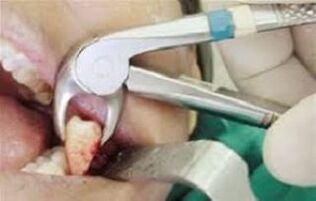 elfbar nachfüll pod läuft aus Dents du fumeur : le tabac nuit à la santé bucco-dentaire main image 1